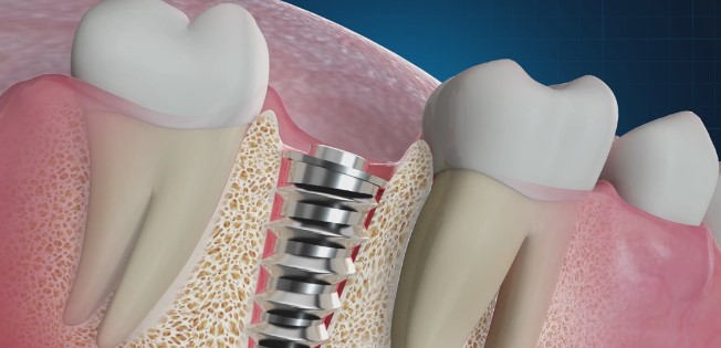 Should I Have Dental Implants?