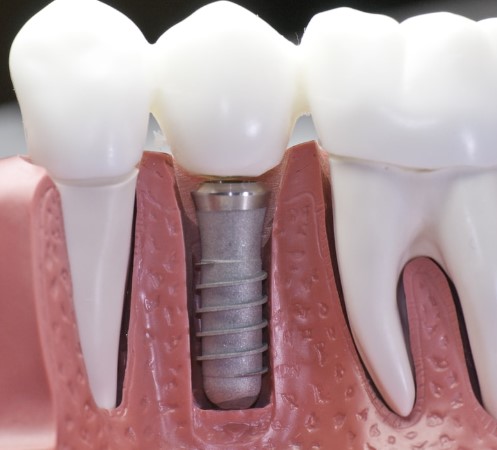 Should I Have Dental Implants, Dental Implants Pros and Cons, Considering Dental Implants, Dental Implants Decision, Dental Implants Evaluation, Dental Implants Candidacy, Dental Implants Consultation, Dental Implants Cost, Dental Implants Procedure, Dental Implants Benefits, Dental Implants Risks, Dental Implants Alternatives, Dental Implants Recovery, Dental Implants Success Rate, Dental Implants Longevity, Dental Implants Maintenance, Dental Implants Aesthetics, Dental Implants Functionality, Dental Implants Comfort, Dental Implants Specialists, Dental Implants Expert Opinion, Dental Implants Oral Health, Dental Implants Missing Teeth, Dental Implants Surgical Process, Dental Implants Permanent Solution